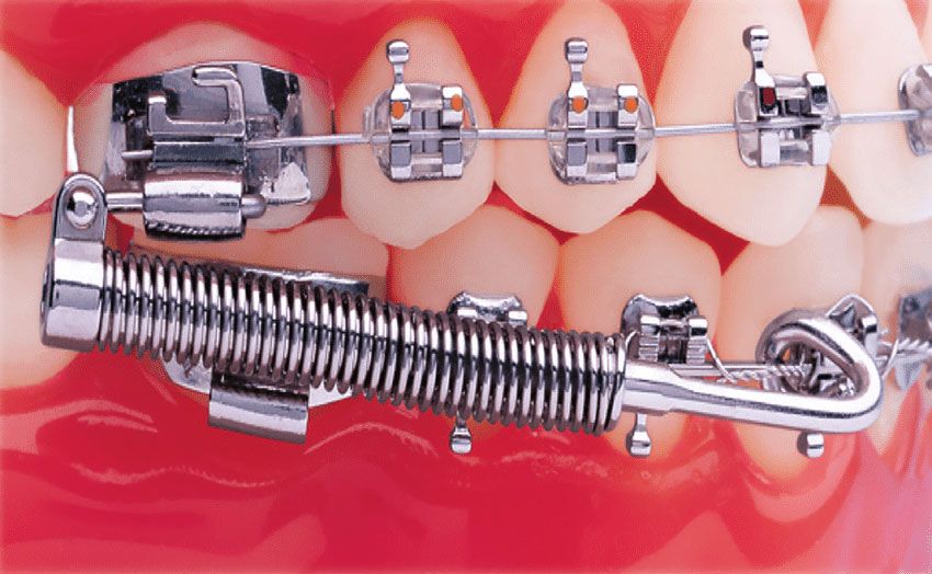 Forsus Fatigue Resistant Device